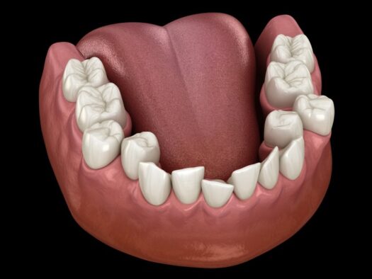 Digital image of crooked and overcrowded teeth.