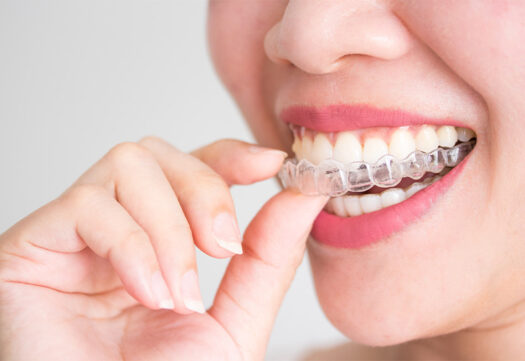 Woman placing Invisalign over top teeth.