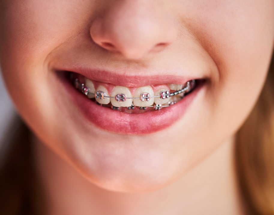 Close up of girl's smile with braces
