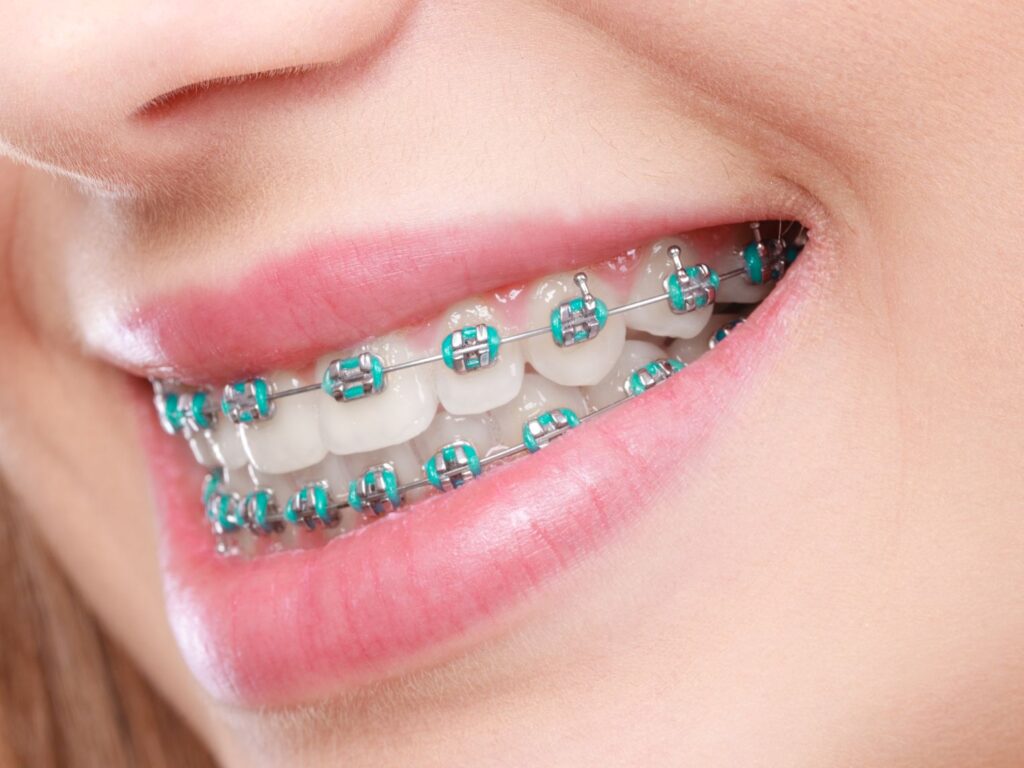 Closeup of someone with braces with teal bands smiling
